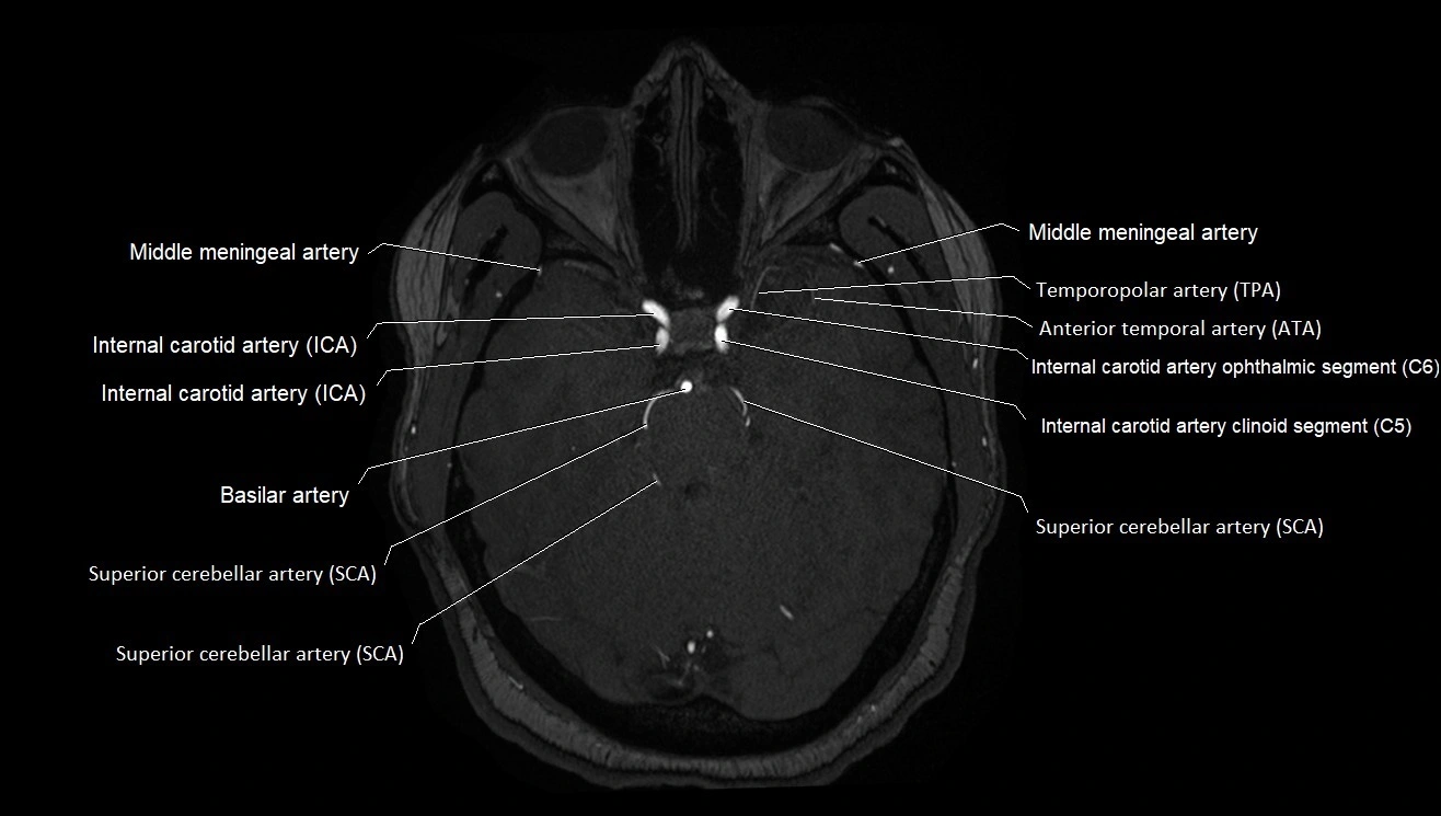 MRA brain (cerebral arteries) anatomy axial 3T image 11.webp